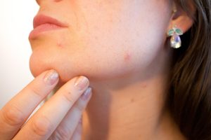 Recent Work acne, pores, skin, pimple, female, face, skincare, infection, treatment, disease, dermatology, facial, person, hygiene, painful, scar, irritation, young, bacteria, pus, caucasian, eruption, sebaceous, blackhead, complexion, hormone, girl, woman, lady, party killer, crisis, emergency, blemish, problems, cheek, sore, cosmetic, adult, spots, products, health, care, problematic, killjoy, inconvenient, timing, party, hacks, chick, epidermis, help, zit, bothersome, annoying, outbreak, makeup, non-comedogenic, foundation, color, tone, undertone, medical, puberty, acne, acne, acne, acne, acne, pimple