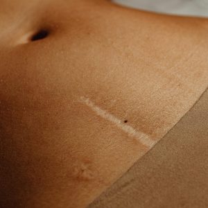 Recent Work Detailed close-up of a woman's abdomen showing a scar and moles, highlighting skin texture.
