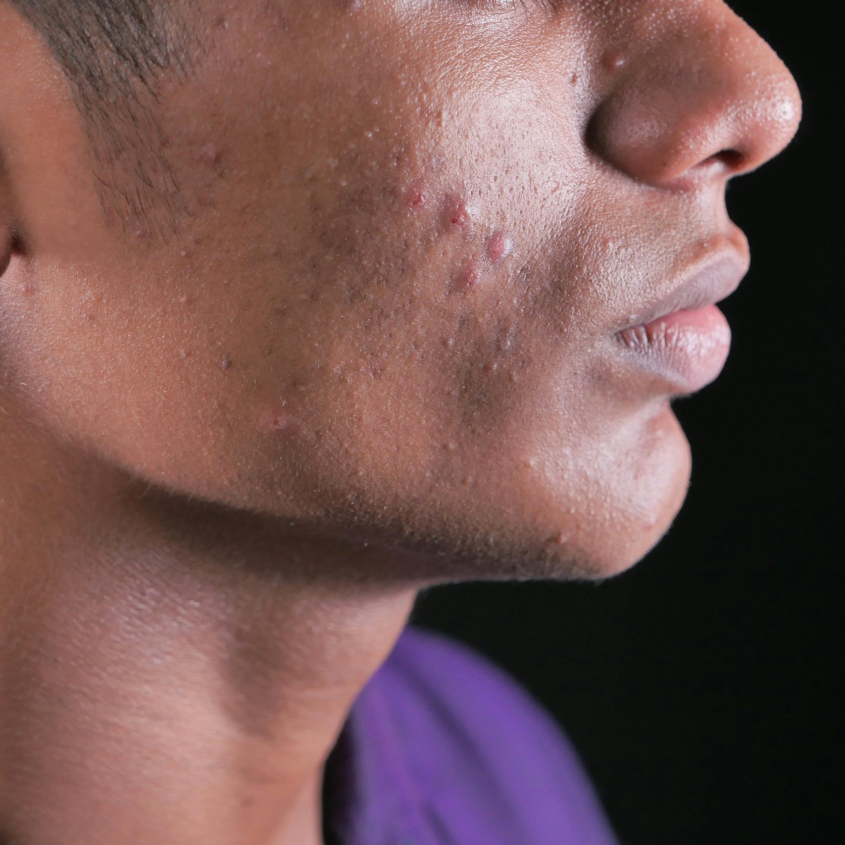 Side view close-up of a young man's face with visible acne on cheek and jawline.